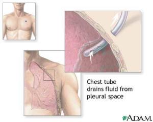 And here is another image of a chest tube, just in case the first one didn't show enough :)